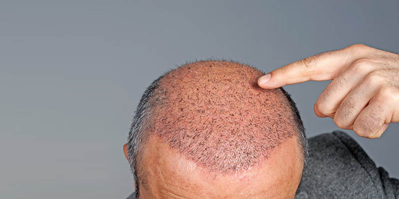 Which Is The Best Method Of Hair Transplant In Bangalore?